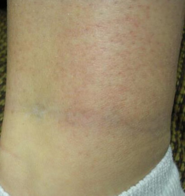Laser Tattoo Remover with Spectra Before and After - Case -1, Image 2 - Male, age  - Baltimore, MD - Skin Therapeutics Med Spa