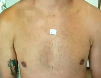 Laser Tattoo Remover with Spectra Before and After - Case 2, Image 2 - Male, age  - Baltimore, MD - Skin Therapeutics Med Spa