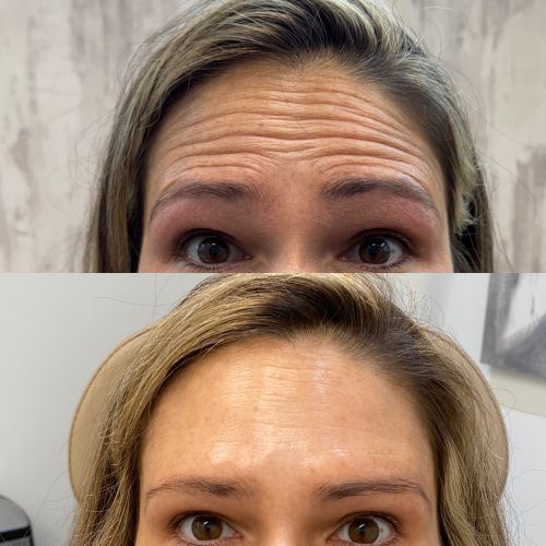 Botox Before and After - Case 16, Image 1 - Female, age 25 – 34 - Baltimore, MD - Skin Therapeutics Med Spa